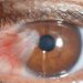 Red eye can occur in one or both eyes.. Image may be subject to copyright.